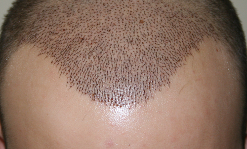 Dr.Keser: Hair Transplants | Follicular Unit Extraction Hair 